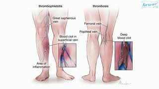 thrombophlebitis