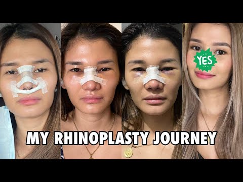 MY RHINOPLASTY JOURNEY - Was it worth it? | Jen Barangan