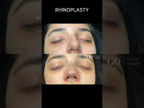 Patient Journey: Rhinoplasty Transformation 🌟