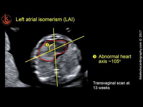 Fetal echocardiography at 11-13 weeks: Left Atrial Isomerism (LAi) & Congenital Heart Block