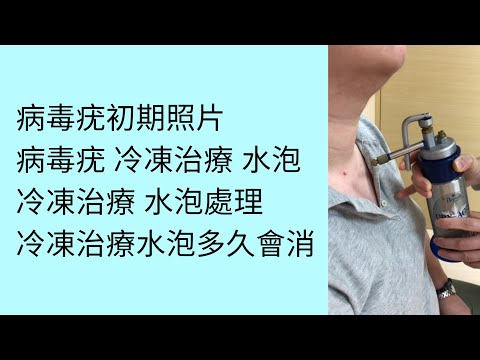 病毒疣 冷凍治療 水泡熱門影片，快來看看病毒疣 冷凍治療 水泡！