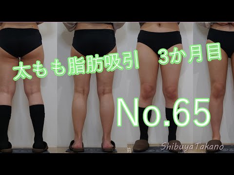 太もも脂肪吸引　3か月目のモニター様　身長155ｃｍ、体重54.5ｋｇ、ＢＭＩ22.7　20代女性