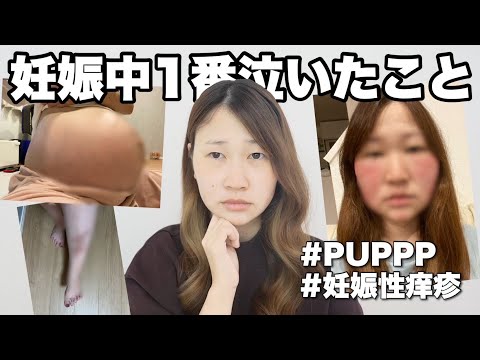 出産より泣いた眠れないほどの蕁麻疹について【PUPPP・妊娠性湿疹】