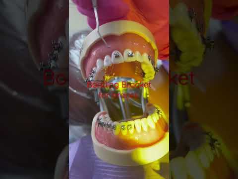 How to bond bracket for braces? #shortsviral #howto #fypshorts #dentalcare #dentalassistant #ortho