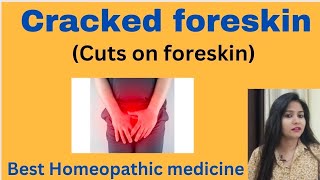 Cracked foreskin (cuts on penis & foreskin)- Cracked foreskin symptoms,causes & Homeopathic medicine