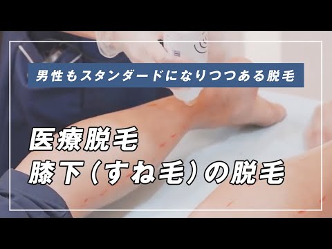 【医療脱毛】男性でも受けられる医療脱毛レーザーのすすめ