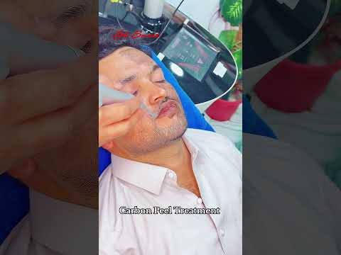 Carbon Peel Treatment #getsmarthairclub #viralvideo #love