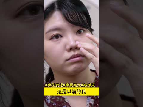 蒜頭鼻透過鼻整形隆鼻手術讓鼻子變精緻了 台北教主 朱立箴醫師