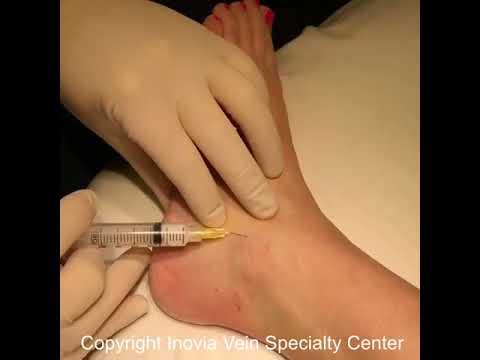 Sclerotherapy Spider Vein Treatment - Inovia Vein Specialty Centers