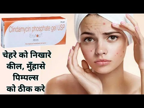 Erytop Gel (Clindamycin) पिम्पल, कील मुहासे की समस्या को ठीक करे how to use Erytop gel #cngajbhiye 