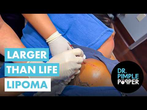 Larger Than Life Lipoma that Dr Pimple Popper Couldn't Believe!