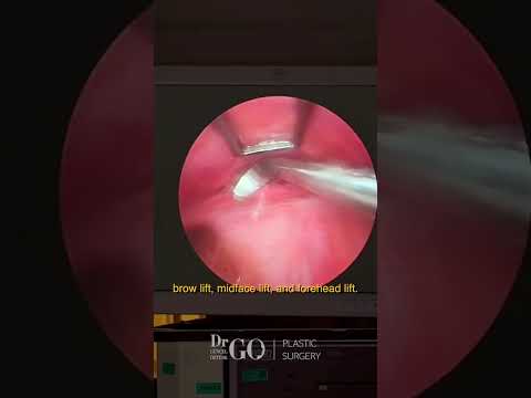 Behind the Scenes: A Day of Pentalift Surgery with Assoc. Prof. Dr. Güncel Öztürk