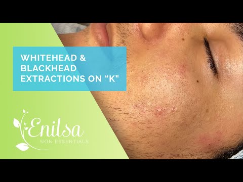 Enilsa is back! Whitehead & Blackhead Extractions on "K" - Part 1