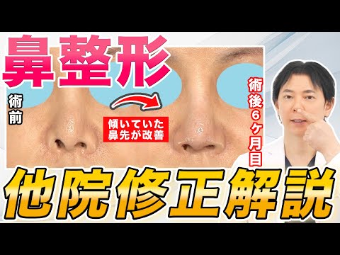 【他院修正】鼻整形を他院で受けられた方の修正症例をご紹介します