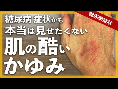 【糖尿病 症状】糖尿病が原因で肌トラブル 身体中の痒み（かゆみ）が止まりません / 皮膚の掻き傷跡が消えません😢