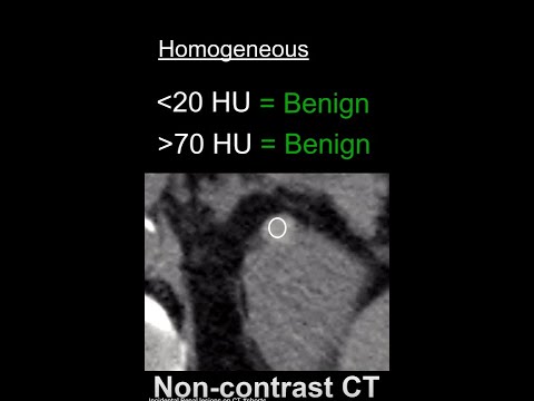 Incidental Renal lesions on CT #shorts