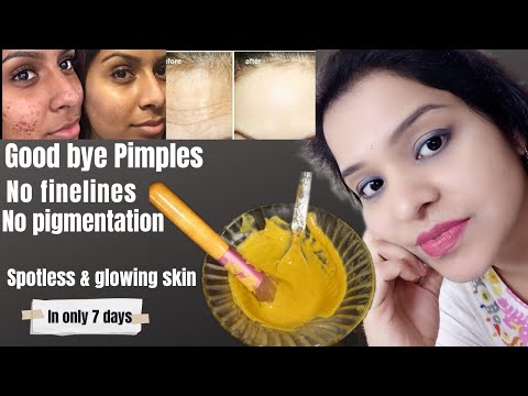 acne pimples or marks ko जड se khatam kare. Jhurion ko हलका करें spotless & glowing skin in 7 days