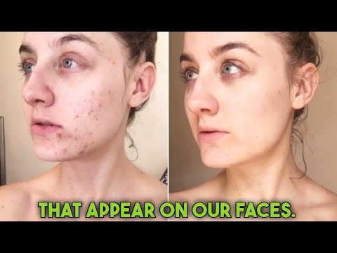 How To Permanently Get Rid Of MELASM, Pigmentation Faster