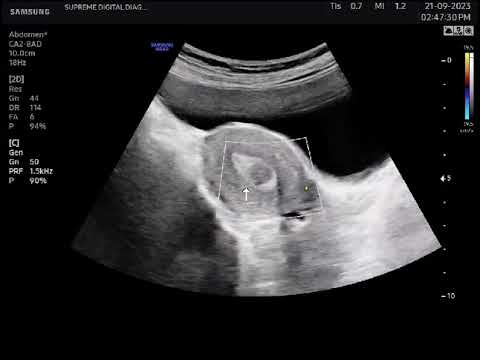 Hypoechoic lesion #health #ultrasound #sonographer #ultrasoundtech #science #anatomy