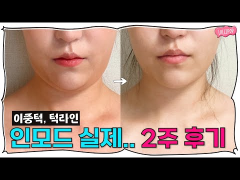 이중턱 없애고 턱라인 살아난 인모드 리프팅 후기 (+효과 확실히 보는 방법)