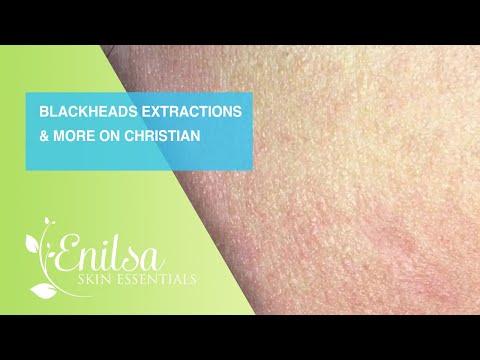 Blackheads Extractions and more on Christian