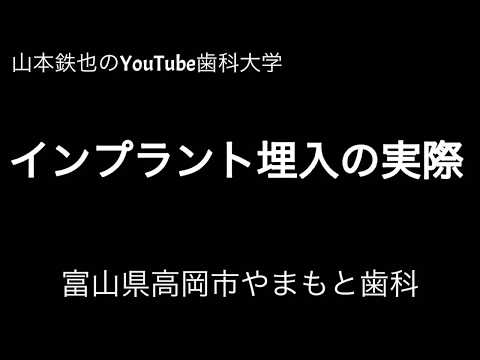 歯科用CTを使いインプラント埋入高岡やまもと歯科0766-28-3100