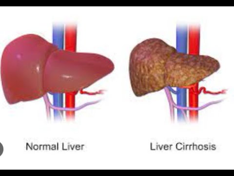 cirrhosis #ultrasound #sonographer #health #ultrasoundtech #science