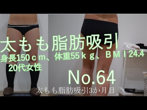 太もも脂肪吸引　64　3か月目までの経過　身長150ｃｍ、体重55ｋｇ、ＢＭＩ24.420代女性