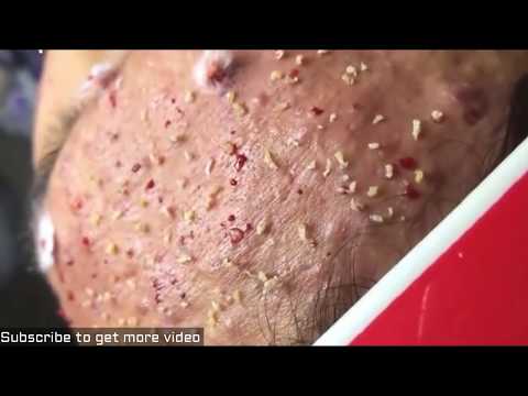 Steroid acne, How To Rid Of Pimples, Milia