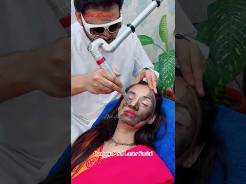 Carbon Peel Laser Facial #getsmarthairclub #beauty #viralvideo #viralshort