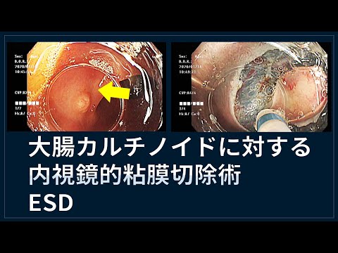 大腸カルチノイドの内視鏡的粘膜切除術(ESD)