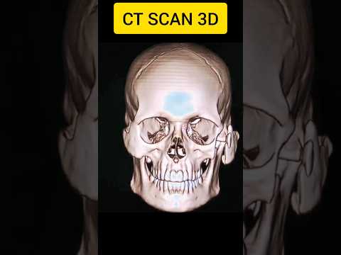 Face Fracture in Accident #orthopedics