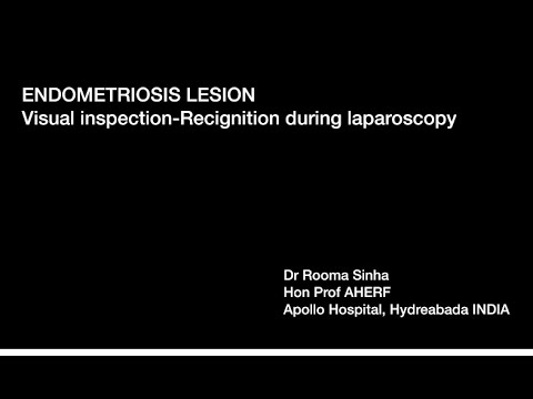 Visual diagnosis of early endometriosis lesions on Laparoscopy Dr rooma Sinha Apollo Hospitals