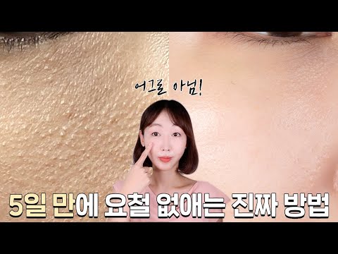 광고❌ 3개월 간 테스트 끝에 알아낸 요철 없애는 '진짜 방법'❗ (+ 스킨케어 루틴, 찐템 추천)