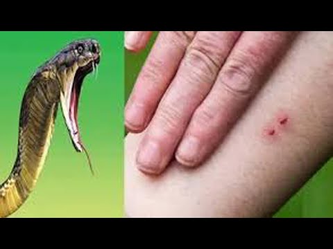 Snake Bite to Six students in Gurukula School at Jagtial