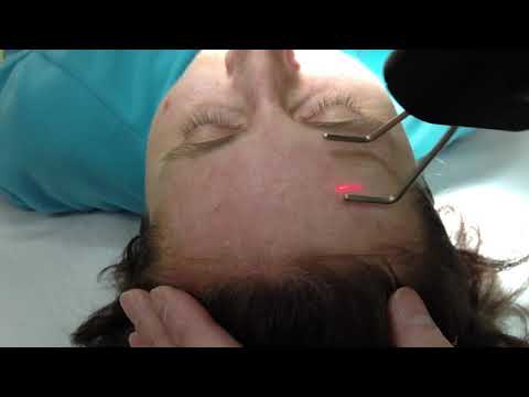 Skin Rejuvenation by MedArt FRx CO2 system