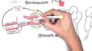 Chronic Kidney Disease (CKD)  Pathophysiology