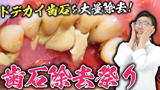 【55歳女性】ドデカ歯石除去祭り🔥　Big tartar removal festival🔥