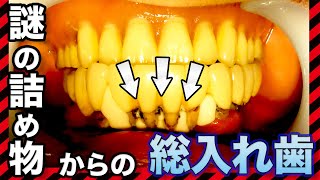 謎の詰め物からの総入れ歯💦Full dentures from mysterious stuffing