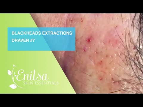 Blackheads Extractions Draven 7th Treatment