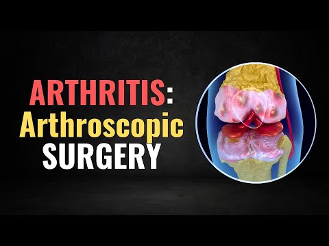 What Science Actually Says About Knee Arthritis Cleanup Surgery