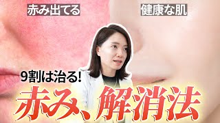 赤みの9割は治る！よくある原因と対処法【実例あり】