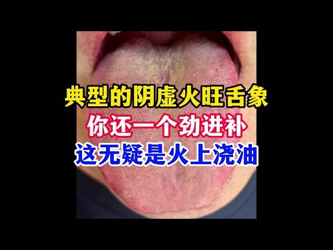 典型的阴虚火旺舌象，你还一个劲进补，这无疑是火上浇油