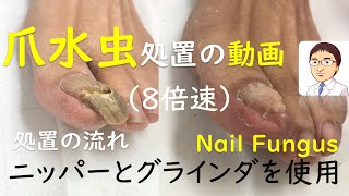 【8倍速】爪水虫（白癬）処置の動画　1分で流れを把握　巻き爪・陥入爪治療の相談室　Treatment of tinea unguium ( Nail fungus)