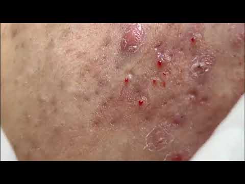 Acne Removal from face, Milia, Skill Acne Remove, Pimple Popper Videos 2019