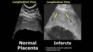 Placenta Ultrasound Normal Vs Abnormal Image Appearances Comparison | Placental Pathologies on USG