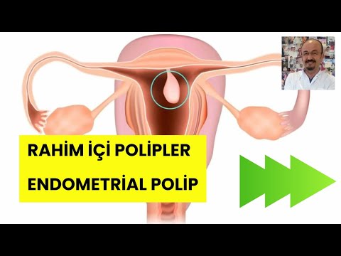 Endometrial Polip, Rahim içi Polipler