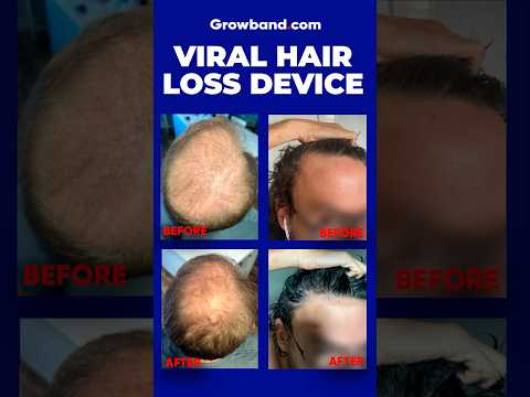 2024 Hair Loss Device - Is It Legit?