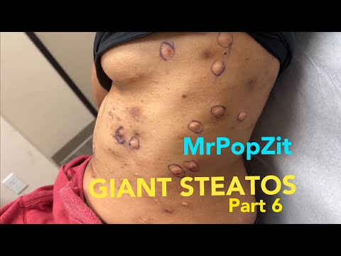 Large Steatocystomas part 6. The story continues. Butter bump drainage and extractions. MrPopZit