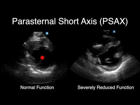 POCUS - Visually Estimating Cardiac Function